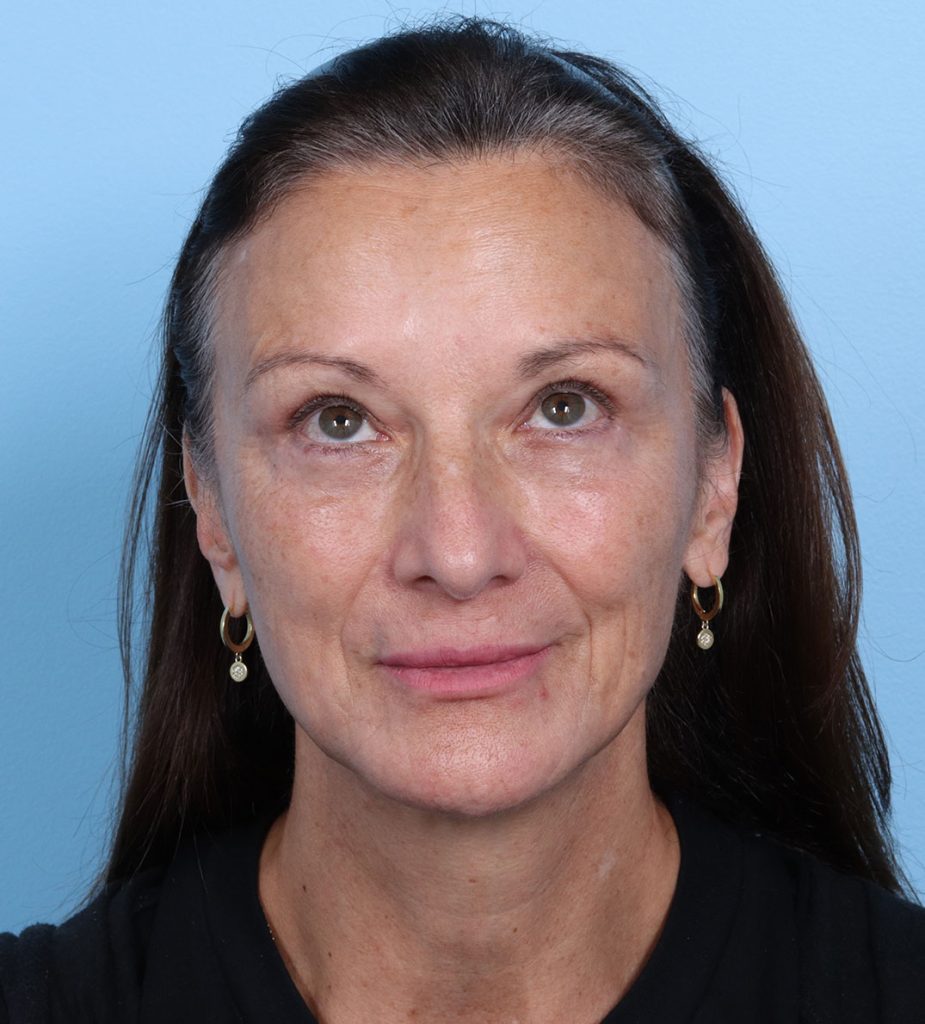 Lower Blepharoplasty - After - Example 1