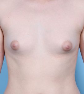 Breast Augmentation - Before - Example 1