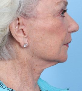 Facelift-Combined Procedures - After - Example 1