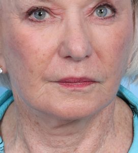 Facelift-Combined Procedures - After - Example 2