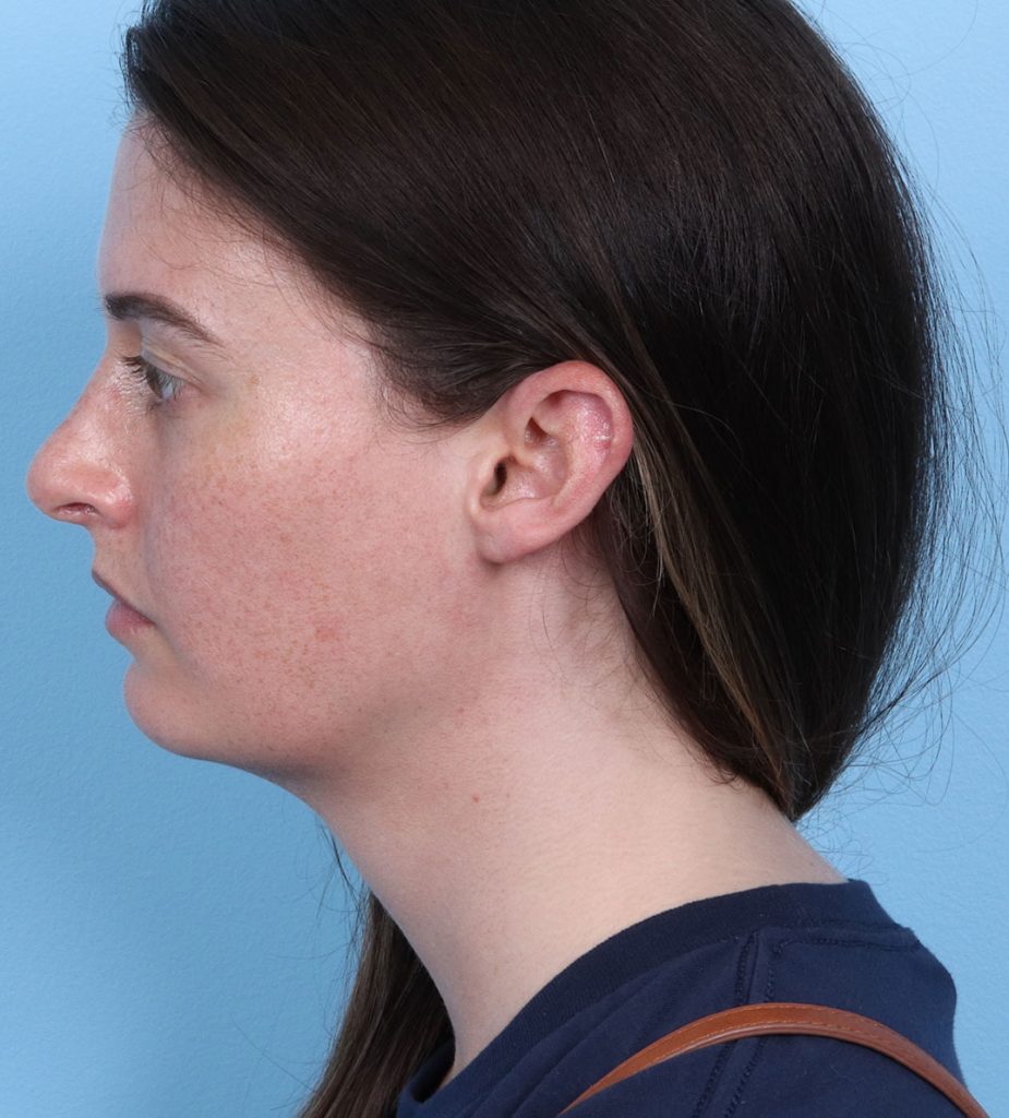 Rhinoplasty - After - Example 1