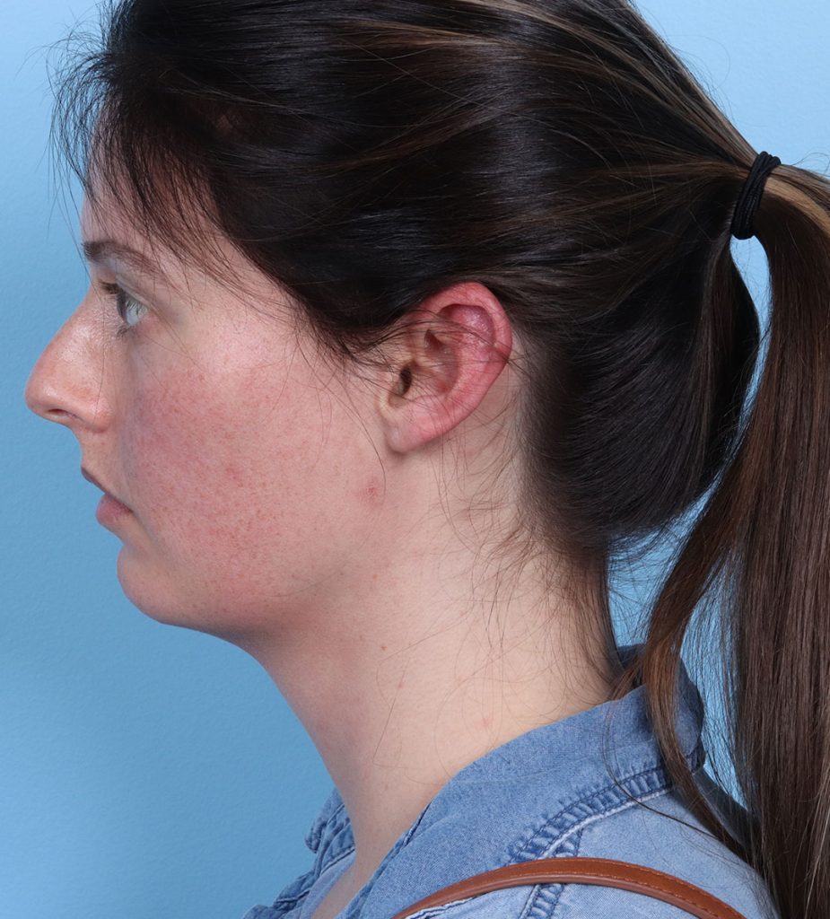 Rhinoplasty - Before - Example 1