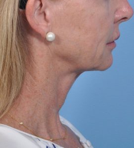 Facelift - Before - Example 1