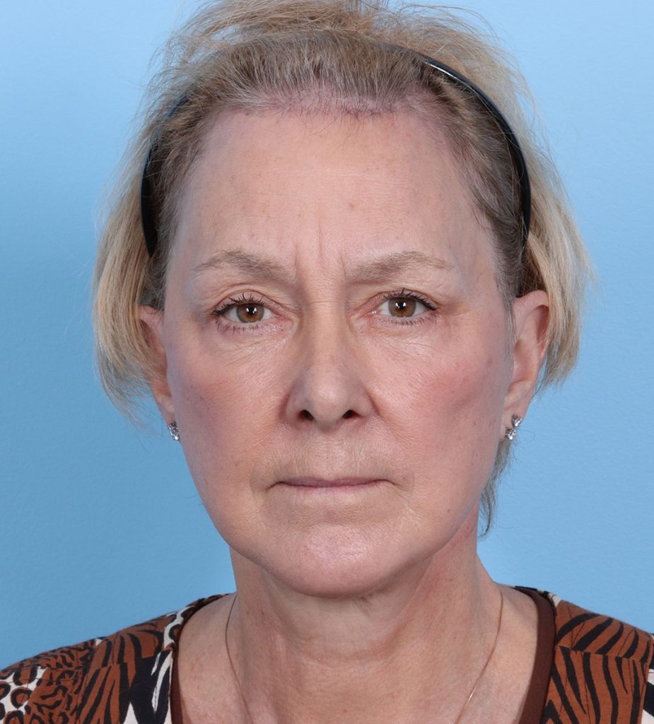 Facelift-Combined Procedures - After - Example 4