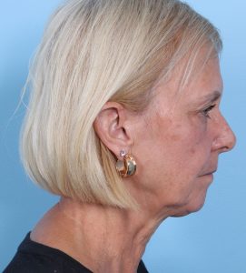 Facelift-Combined Procedures - Before - Example 3
