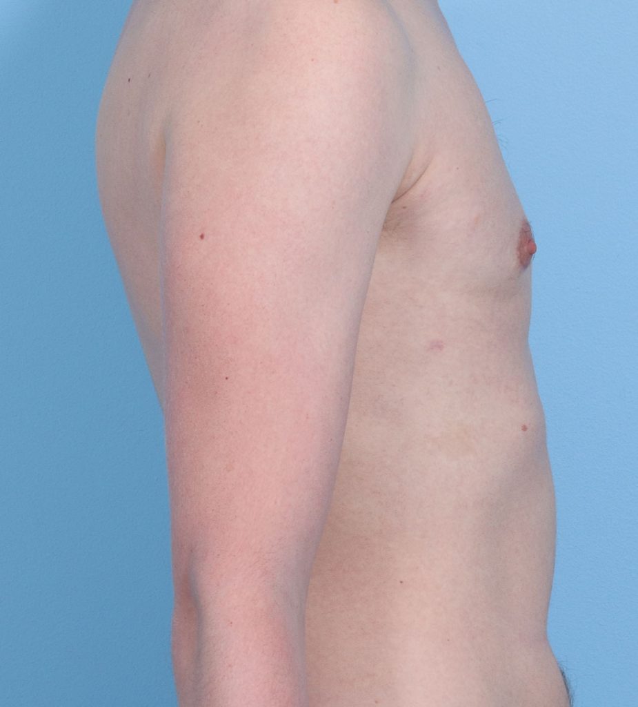 Gynecomastia - After - Example 1