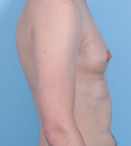 Gynecomastia - Before - Example 1