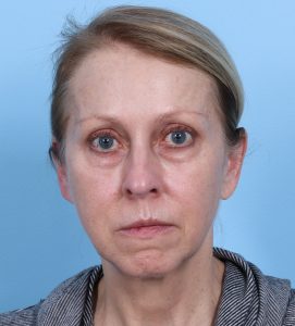 Facelift-Combined Procedures - Before - Example 6