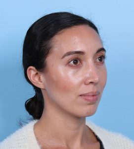 Rhinoplasty - After - Example 13