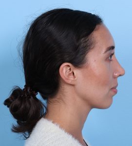 Rhinoplasty - After - Example 14