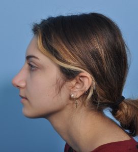 Rhinoplasty - After - Example 17