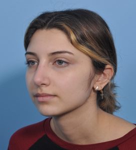 Rhinoplasty - After - Example 18