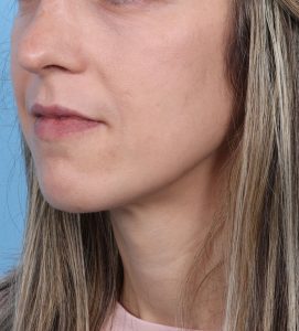 Rhinoplasty - After - Example 19