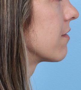 Rhinoplasty - After - Example 20