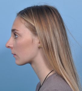 Rhinoplasty - After - Example 12