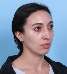 Rhinoplasty - Before - Example 13