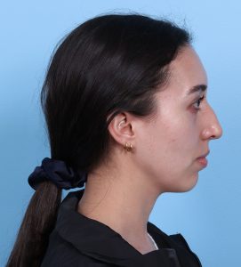 Rhinoplasty - Before - Example 14