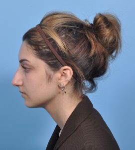 Rhinoplasty - Before - Example 17