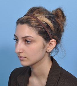 Rhinoplasty - Before - Example 18