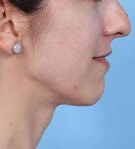 Rhinoplasty - Before - Example 20