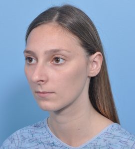 Rhinoplasty - Before - Example 11