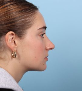 Rhinoplasty - After - Example 4