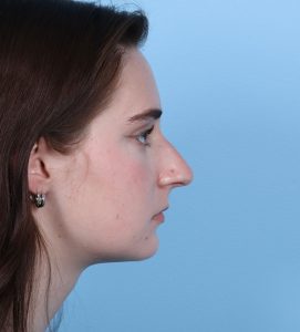 Rhinoplasty - Before - Example 4