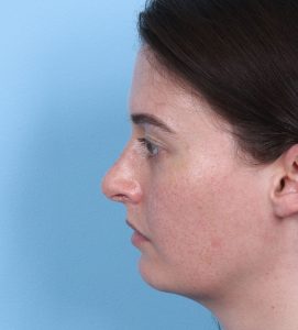 Rhinoplasty - After - Example 1