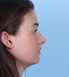 Rhinoplasty - After - Example 2