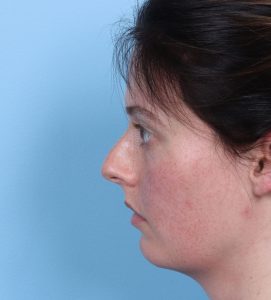 Rhinoplasty - Before - Example 1