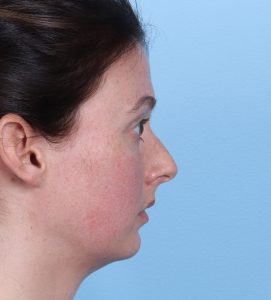 Rhinoplasty - Before - Example 2