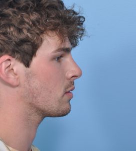 Rhinoplasty - After - Example 10