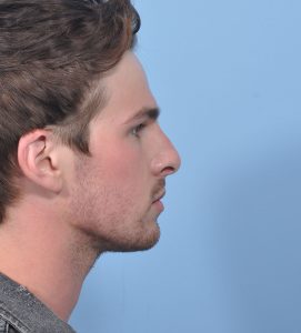 Rhinoplasty - Before - Example 10