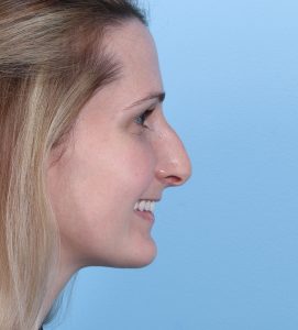 Rhinoplasty - Before - Example 3