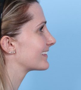 Rhinoplasty - After - Example 3